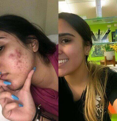 Two side-by-side images showing before and after acne treatment results on a young woman's face.