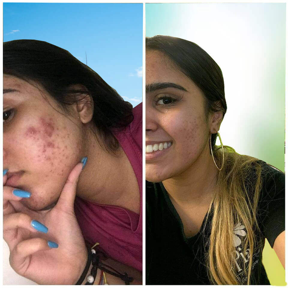 Before and after acne treatment comparison showing clear skin improvement on woman's face.